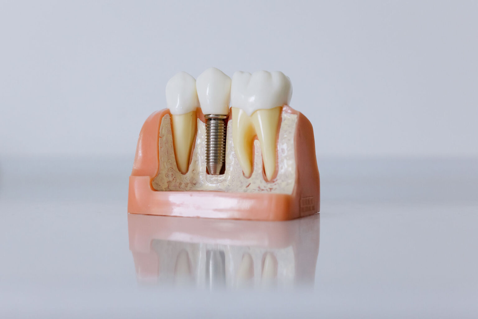 Model of a dental implant fitted between two natural teeth in a section of jaw
